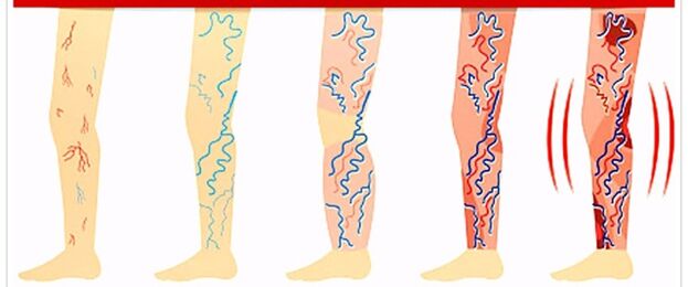 što ne raditi s proširenim venama