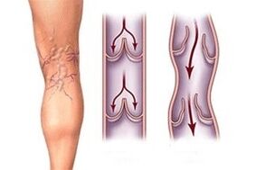odljev krvi u varikoznim venama u različitim fazama razvoja bolesti